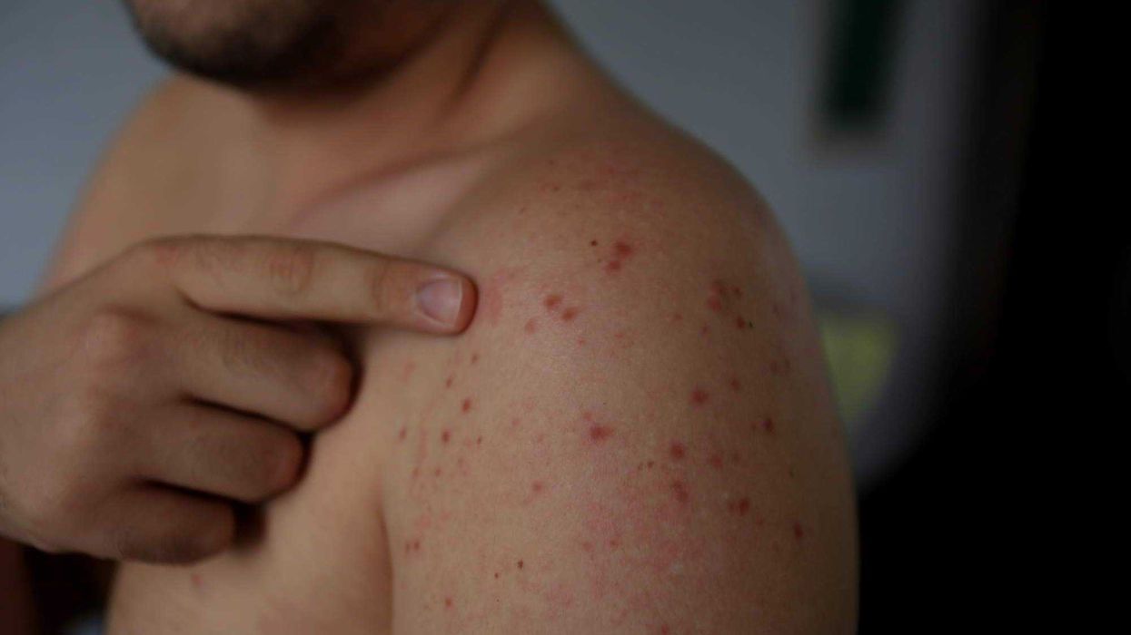 Cuatro muertes por sarampión en México, entre ellas tres menores de edad.