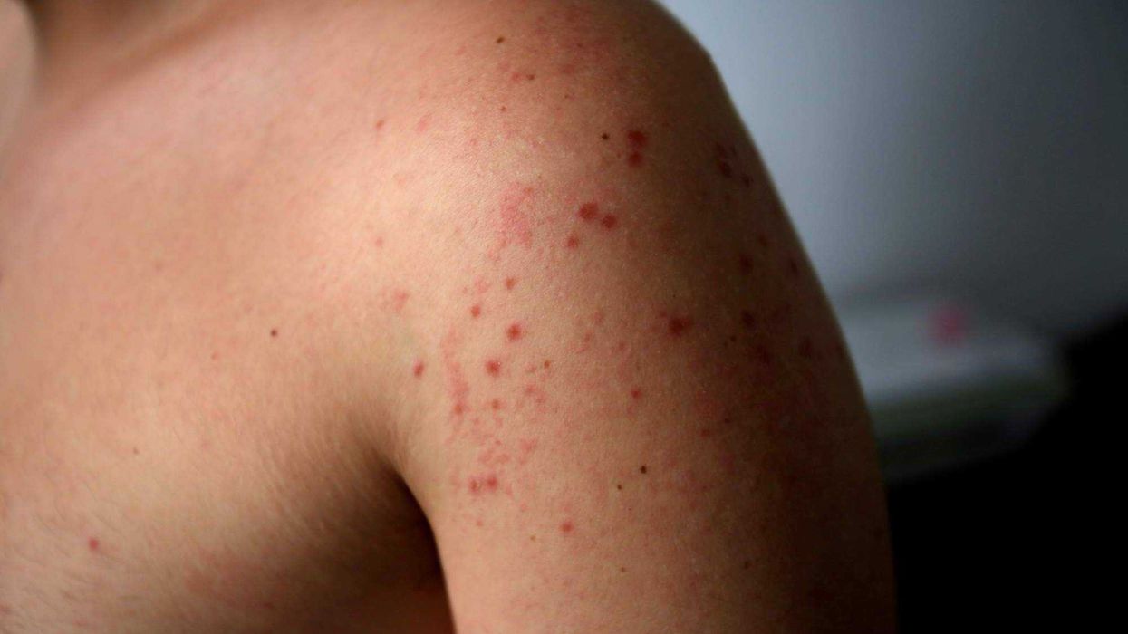 El Departamento de Salud de Carolina del Sur instaló clínicas móviles de vacunación en los condados de Greenville y Spartanburg para contener el brote que afecta a 111 personas.